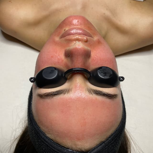 ✨Microneedle Standalone Pkg at Reset Studio in Springfield, MO