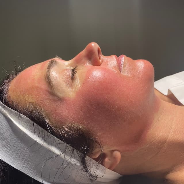 ✨Microneedle Facial Pkg at Reset Studio in Springfield, MO